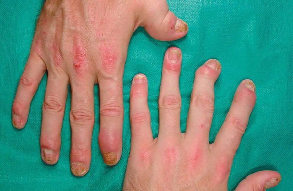 allergia parasiitidele kehas