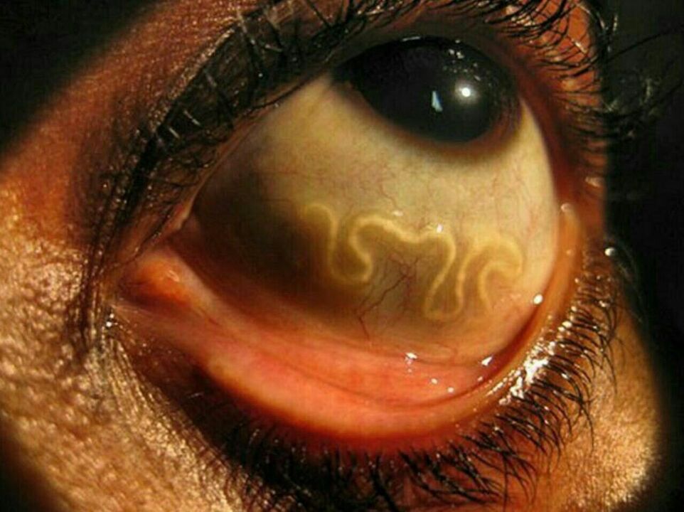 parasiidid inimese silmas